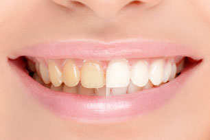 Ursachen von Zahnverfärbungen